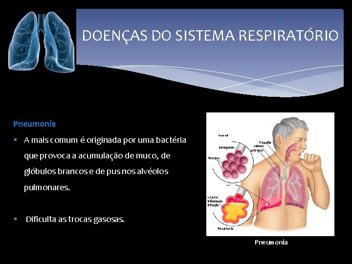 DOENÇAS DO SISTEMA RESPIRATÓRIO Pneumonia § A mais comum é originada por uma bactéria