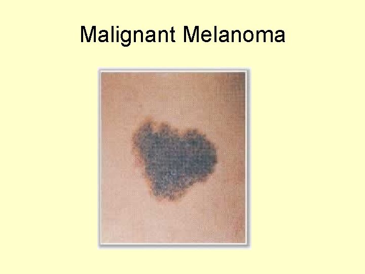 Malignant Melanoma 