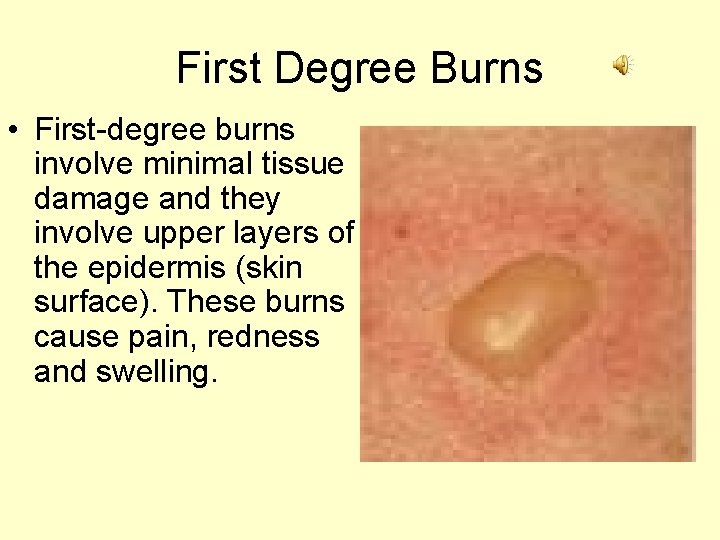 First Degree Burns • First-degree burns involve minimal tissue damage and they involve upper