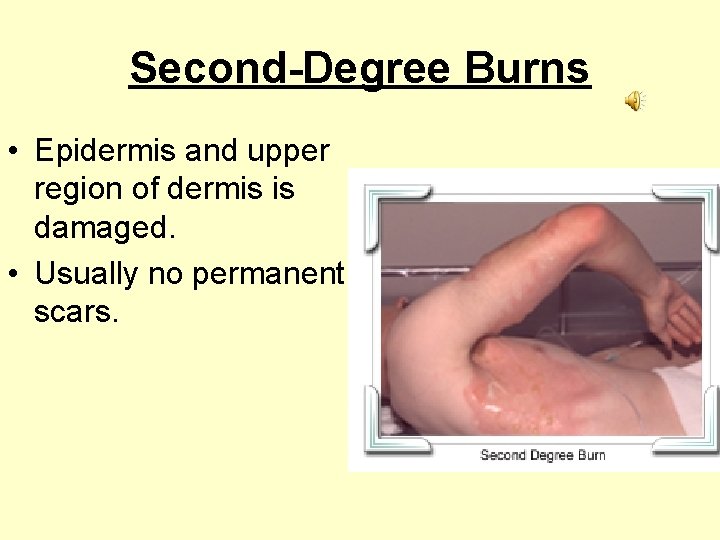 Second-Degree Burns • Epidermis and upper region of dermis is damaged. • Usually no
