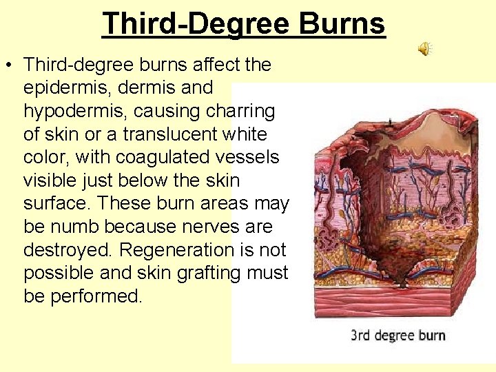 Third-Degree Burns • Third-degree burns affect the epidermis, dermis and hypodermis, causing charring of