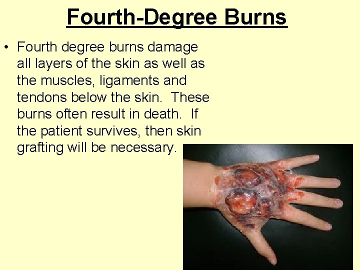 Fourth-Degree Burns • Fourth degree burns damage all layers of the skin as well