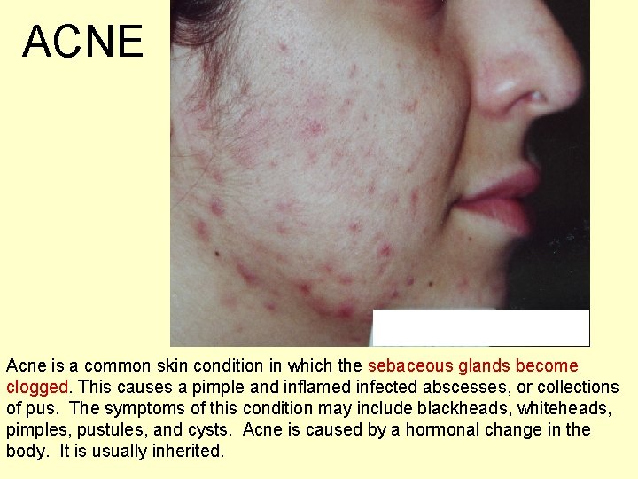 ACNE Acne is a common skin condition in which the sebaceous glands become clogged.