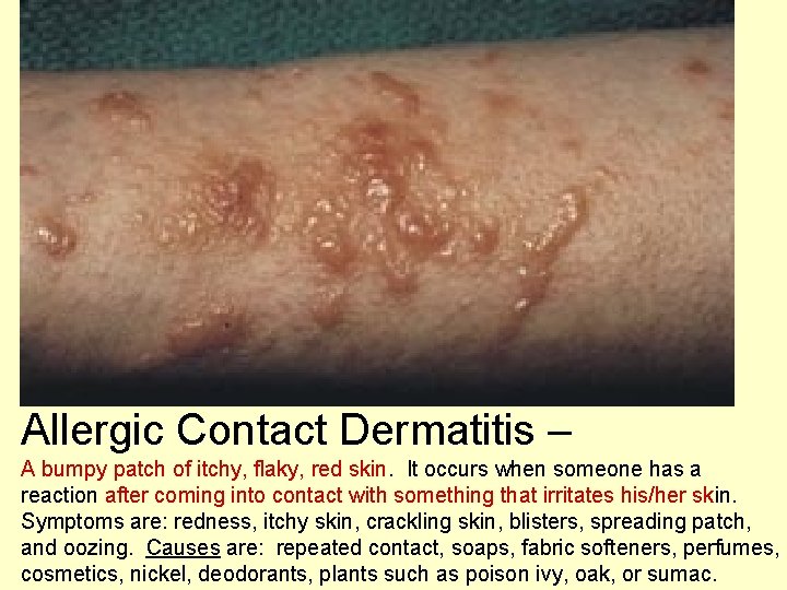 Allergic Contact Dermatitis – A bumpy patch of itchy, flaky, red skin. It occurs