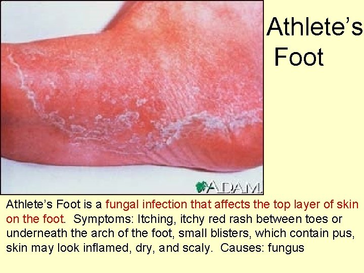 Athlete’s Foot is a fungal infection that affects the top layer of skin on