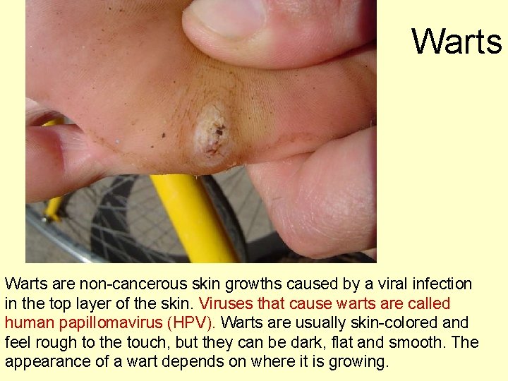 Warts are non-cancerous skin growths caused by a viral infection in the top layer