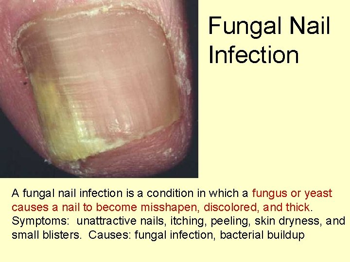 Fungal Nail Infection A fungal nail infection is a condition in which a fungus