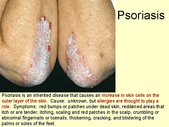 Psoriasis is an inherited disease that causes an increase in skin cells on the