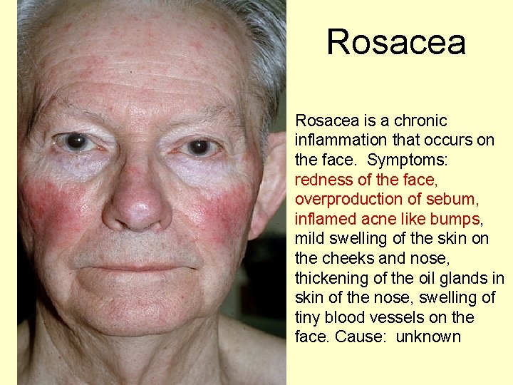 Rosacea is a chronic inflammation that occurs on the face. Symptoms: redness of the