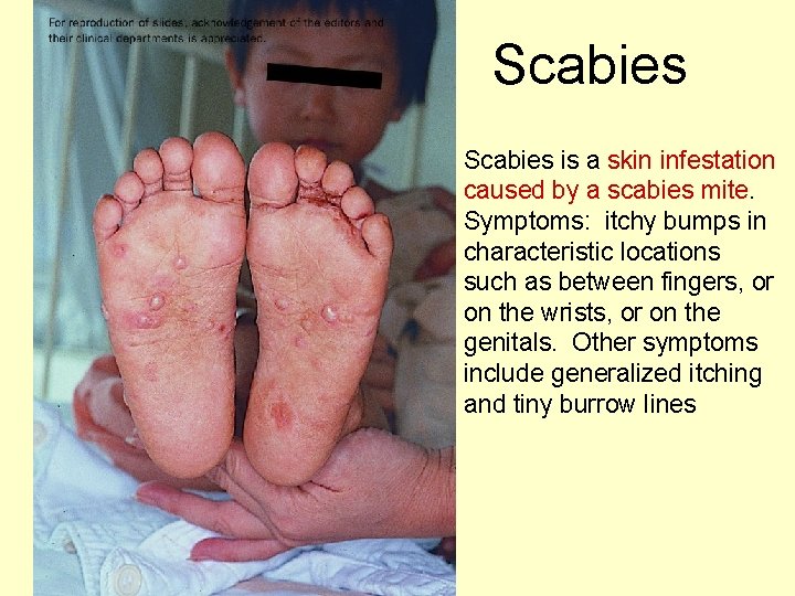 Scabies is a skin infestation caused by a scabies mite. Symptoms: itchy bumps in