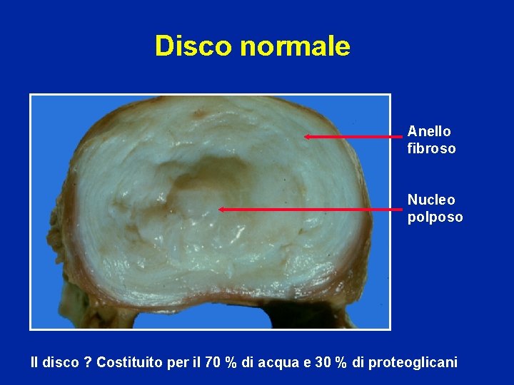 Disco normale Anello fibroso Nucleo polposo Il disco ? Costituito per il 70 %