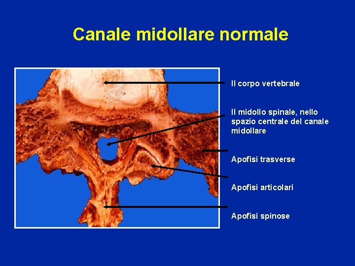 Canale midollare normale Il corpo vertebrale Il midollo spinale, nello spazio centrale del canale