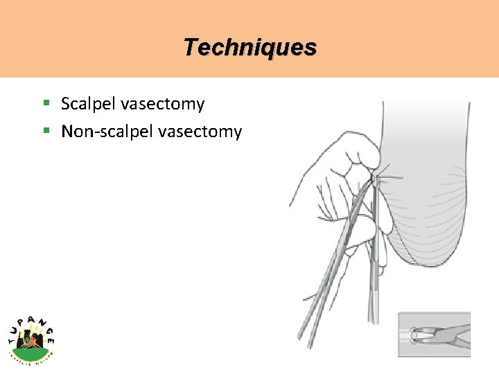 Techniques § Scalpel vasectomy § Non-scalpel vasectomy 