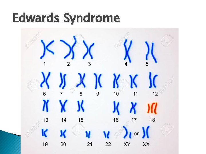 Edwards Syndrome 