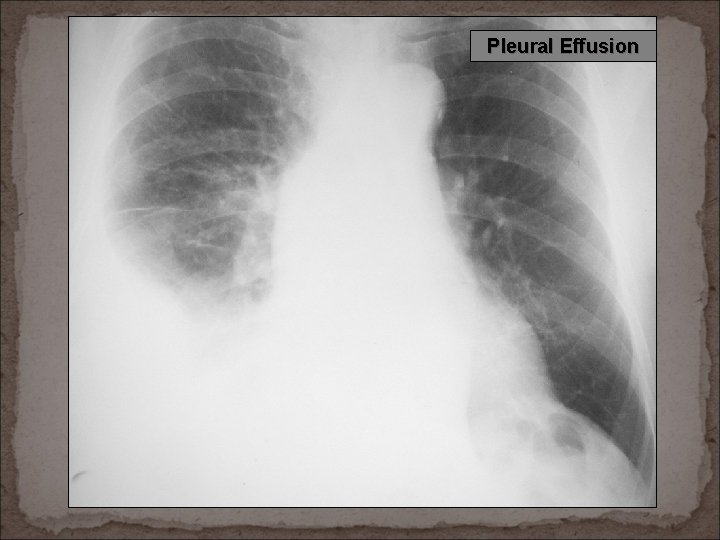 Pleural Effusion 