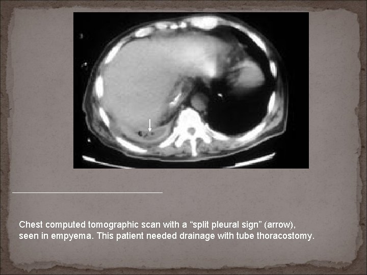 Chest computed tomographic scan with a “split pleural sign” (arrow), seen in empyema. This