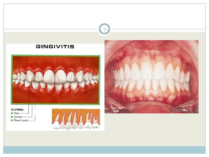 1 CHAPTER 16 MEASURING PERIODONTAL DISEASE GINGIVITIS 2