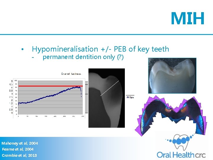 MIH • Hypomineralisation +/- PEB of key teeth - Mahoney et al, 2004 Fearne