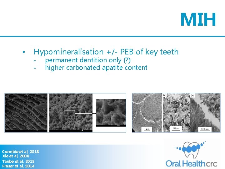 MIH • Hypomineralisation +/- PEB of key teeth - Crombie et al, 2013 Xie