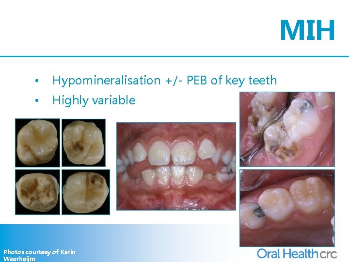 MIH • Hypomineralisation +/- PEB of key teeth • Highly variable Photos courtesy of