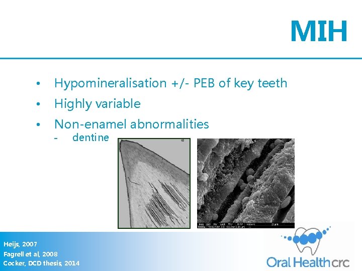 MIH • Hypomineralisation +/- PEB of key teeth • Highly variable • Non-enamel abnormalities