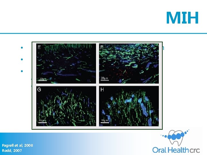 MIH • Hypomineralisation +/- PEB of key teeth • Highly variable • Non-enamel abnormalities