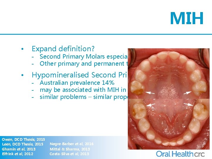 MIH • Expand definition? • Hypomineralised Second Primary Molars (HSPM) - Second Primary Molars