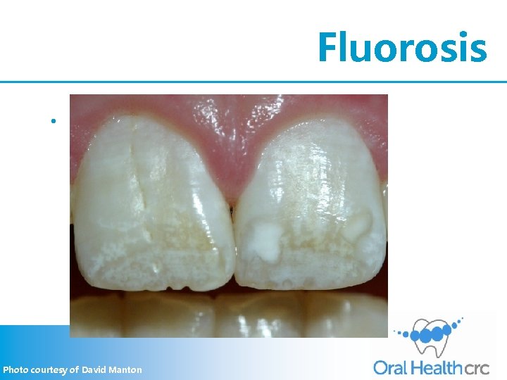 Fluorosis • Diagnosis - primary teeth spared fluoride history other diagnoses not mutually exclusive