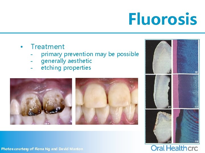 Fluorosis • Treatment - primary prevention may be possible generally aesthetic etching properties Photos