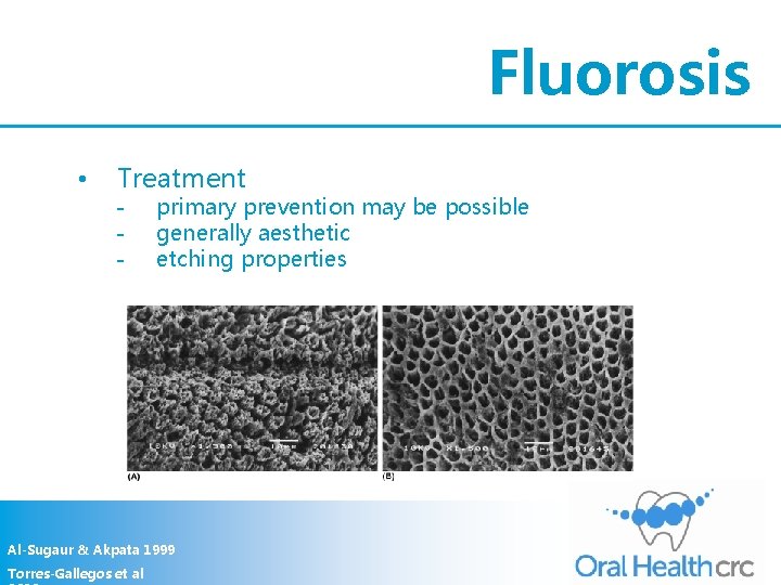 Fluorosis • Treatment - primary prevention may be possible generally aesthetic etching properties Al-Sugaur