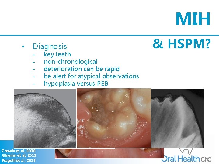 MIH • Diagnosis - Chawla et al, 2008 Ghanim et al, 2015 Fragelli et