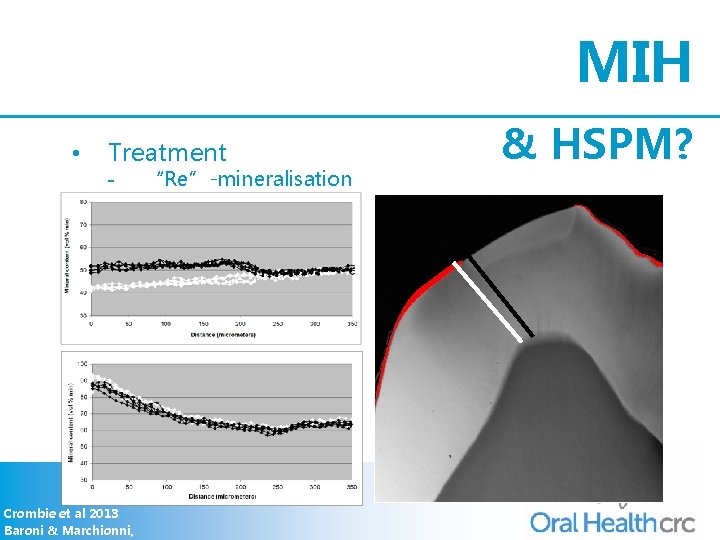 MIH • Treatment - Crombie et al 2013 Baroni & Marchionni, “Re”-mineralisation & HSPM?