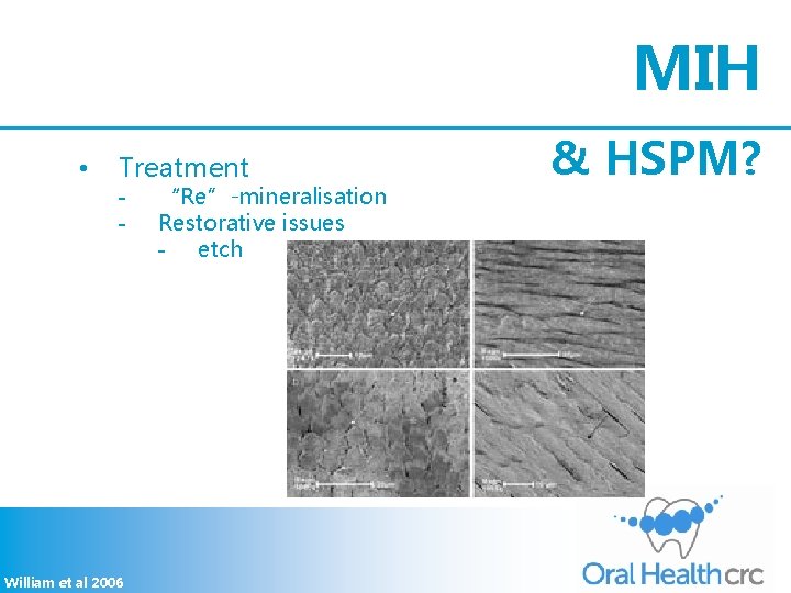 MIH • Treatment - William et al 2006 “Re”-mineralisation Restorative issues - etch &