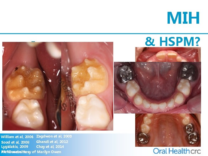 MIH • Treatment - “Re”-mineralisation Restorative issues - etch - pre-treatment - recommendations -