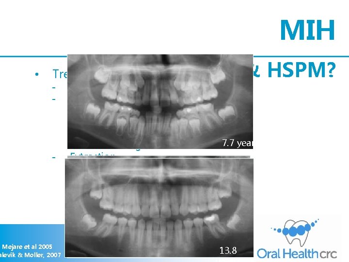 MIH • Treatment - - Mejare et al 2005 alevik & Moller, 2007 &