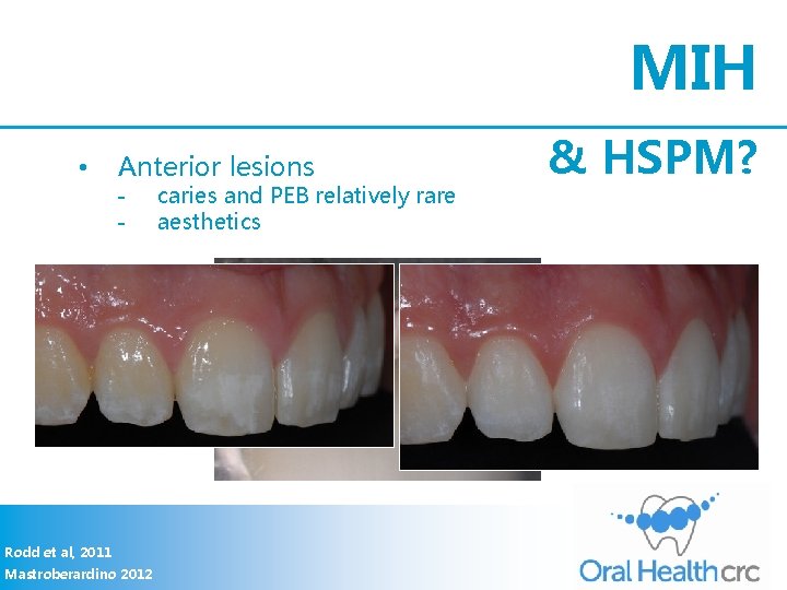 MIH • Anterior lesions - Rodd et al, 2011 Mastroberardino 2012 caries and PEB