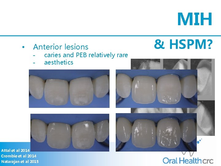 MIH • Anterior lesions - Attal et al 2014 Crombie et al 2014 Natarajan