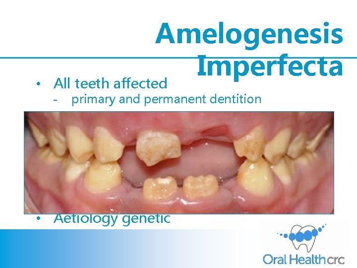  • Amelogenesis Imperfecta All teeth affected - primary and permanent dentition • Variety