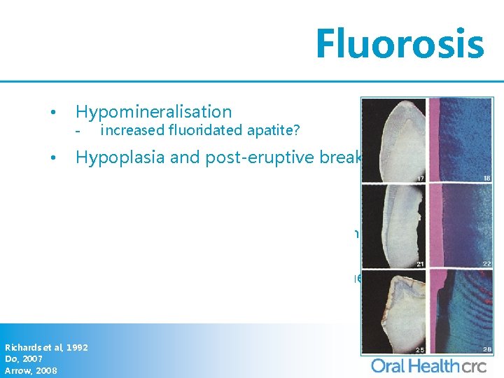 Fluorosis • Hypomineralisation - increased fluoridated apatite? • Hypoplasia and post-eruptive breakdown (PEB) •
