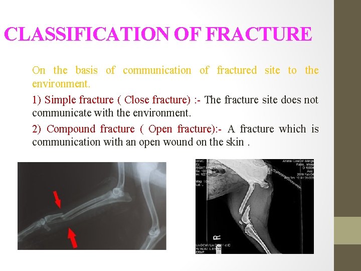 CLASSIFICATION OF FRACTURE On the basis of communication of fractured site to the environment.