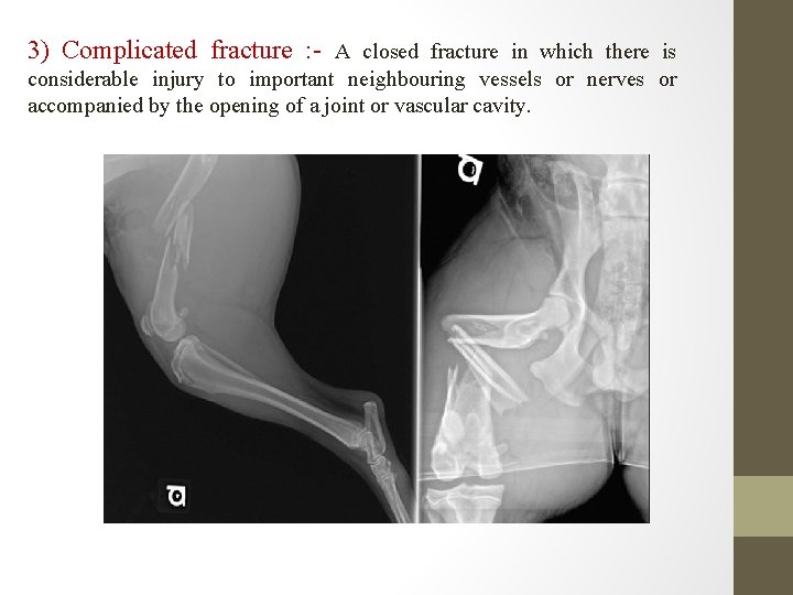 3) Complicated fracture : - A closed fracture in which there is considerable injury