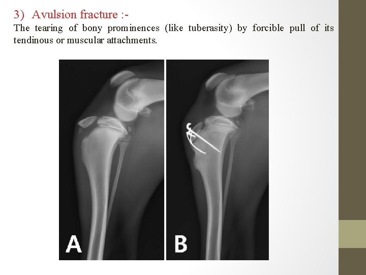 3) Avulsion fracture : The tearing of bony prominences (like tuberasity) by forcible pull