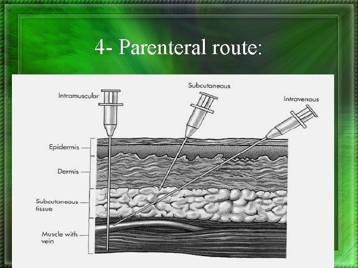 4 - Parenteral route: 