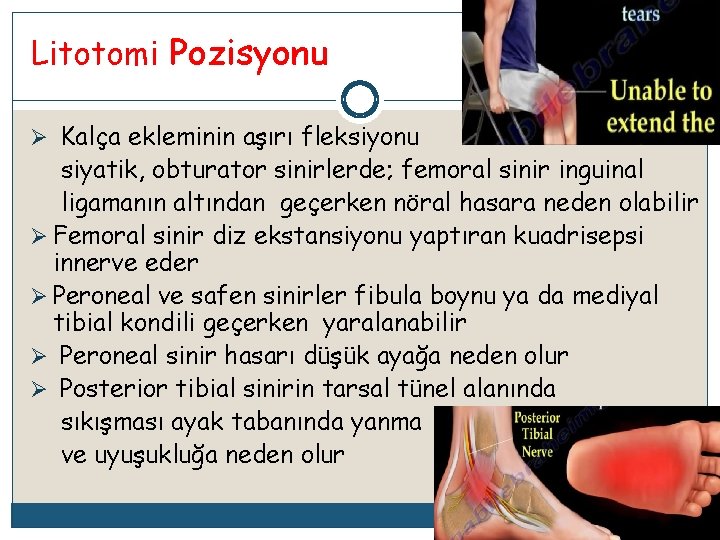 Litotomi Pozisyonu Ø Kalça ekleminin aşırı fleksiyonu siyatik, obturator sinirlerde; femoral sinir inguinal ligamanın