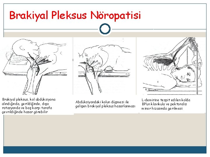 Brakiyal Pleksus Nöropatisi Brakiyal pleksus, kol abdüksiyona alındığında, gerildiğinde, dışa rotasyonda ve baş karşı