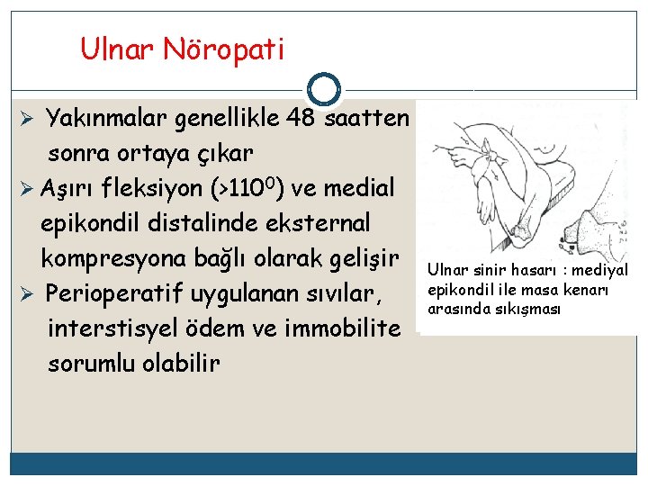 Ulnar Nöropati Ø Yakınmalar genellikle 48 saatten sonra ortaya çıkar Ø Aşırı fleksiyon (>1100)
