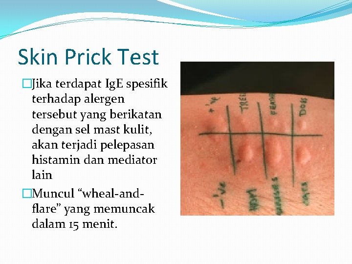 Skin Prick Test �Jika terdapat Ig. E spesifik terhadap alergen tersebut yang berikatan dengan