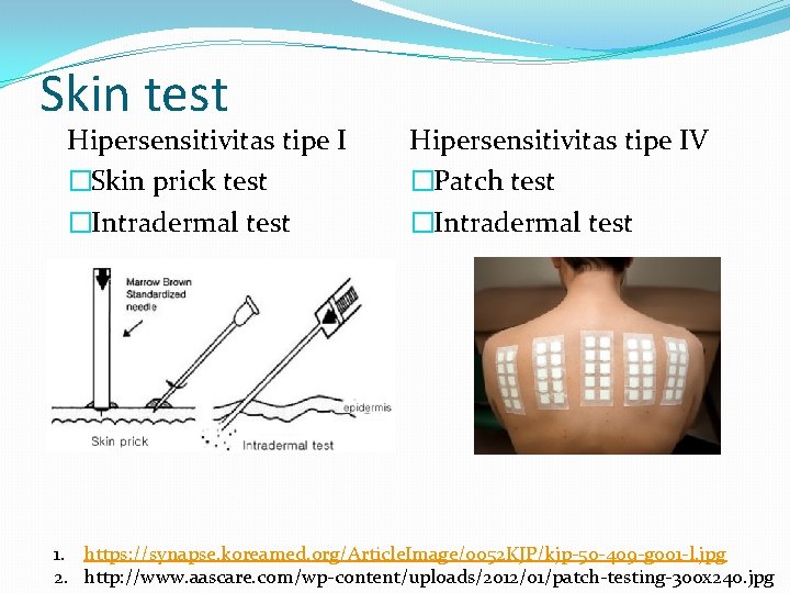 Skin test Hipersensitivitas tipe I �Skin prick test �Intradermal test Hipersensitivitas tipe IV �Patch