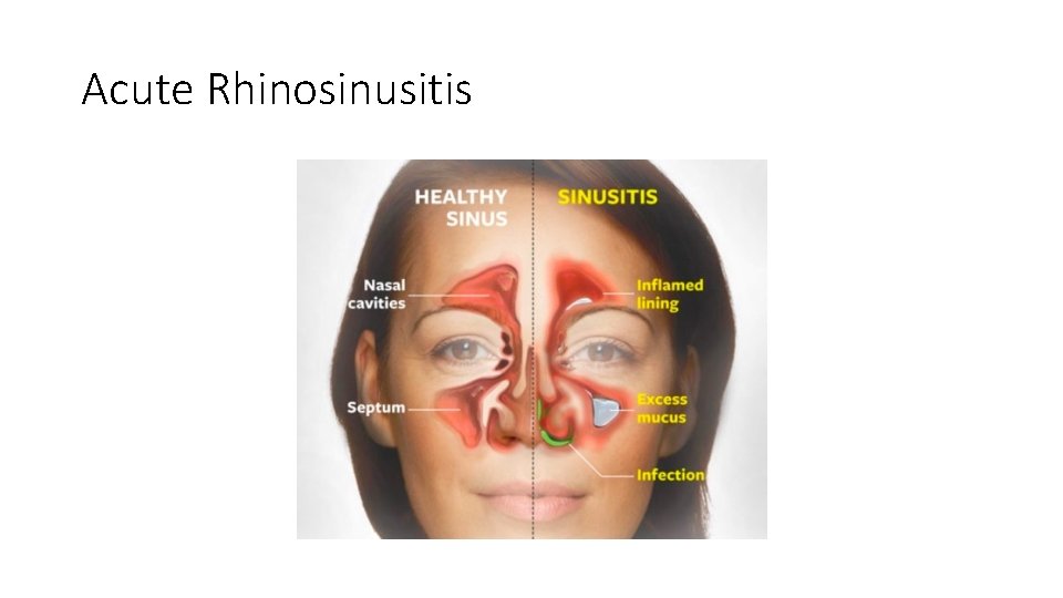 Acute Rhinosinusitis 