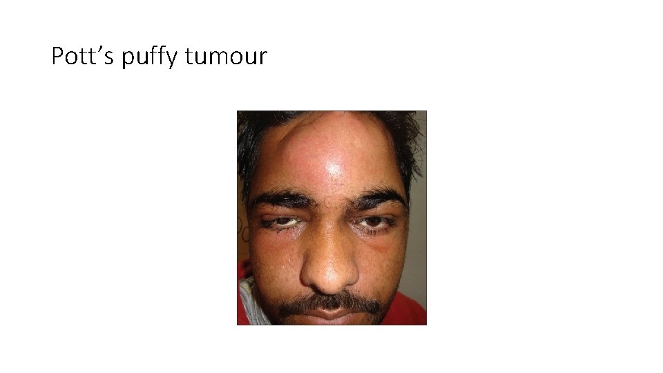 Pott’s puffy tumour 
